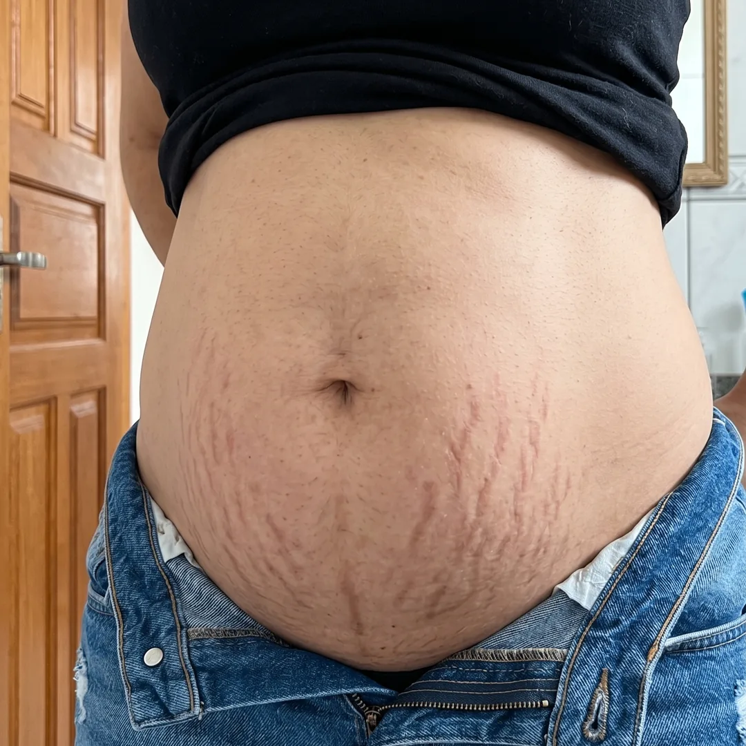 Resultado Creme para Estrias Bumma antes