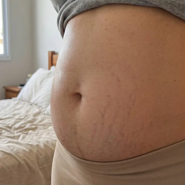 Resultado Creme para Estrias Bumma depois