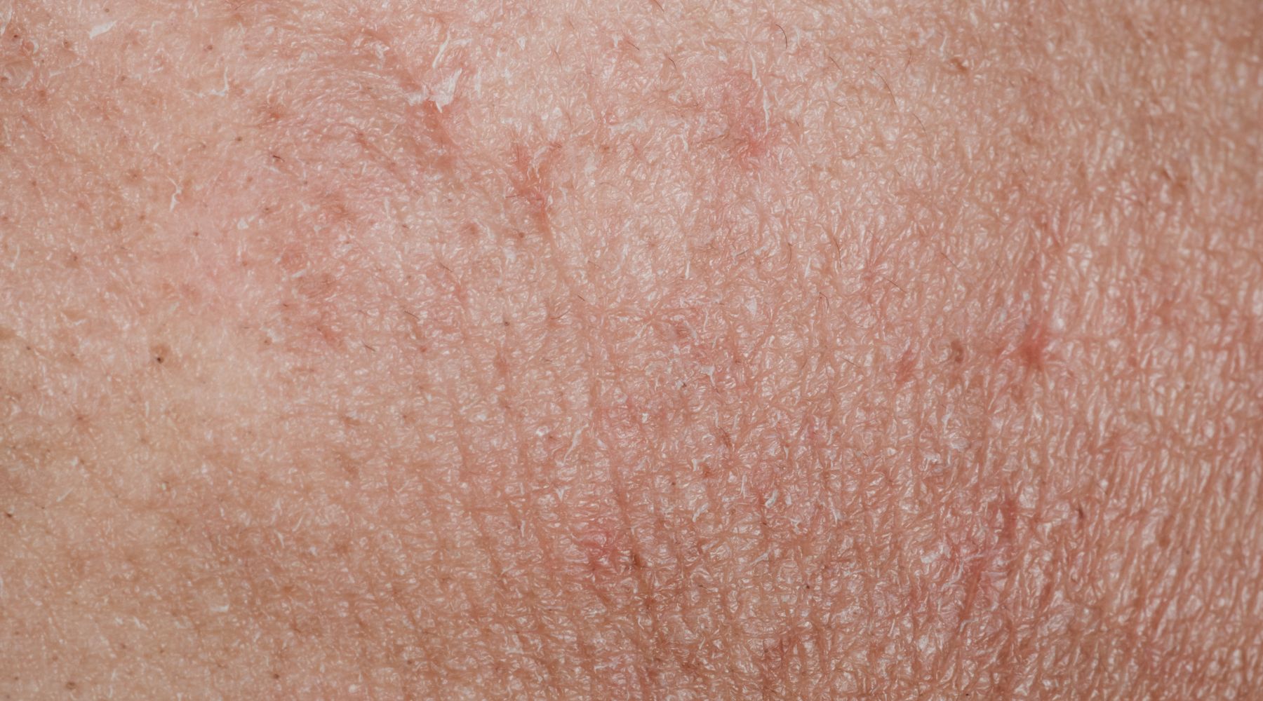 Pele ressecada e sem elasticidade